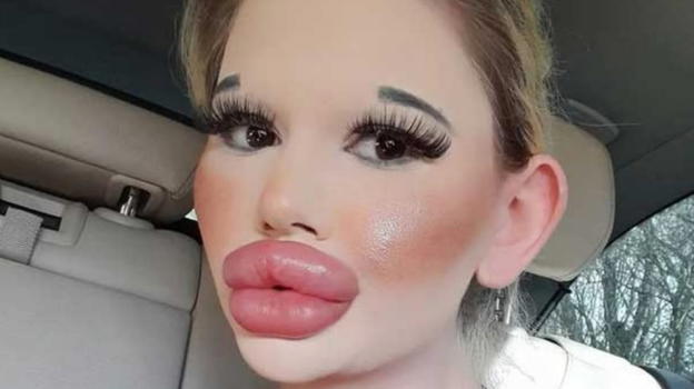 27 iniezioni alle labbra e ritocchini al viso, si chiama Andrea ed è la donna con le labbra più grandi del mondo