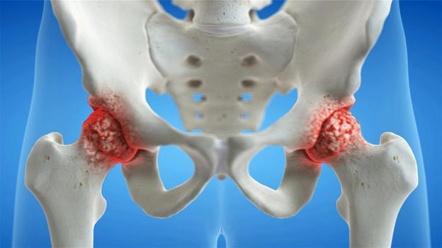 Osteoporosi, come alimentarsi per prevenirla