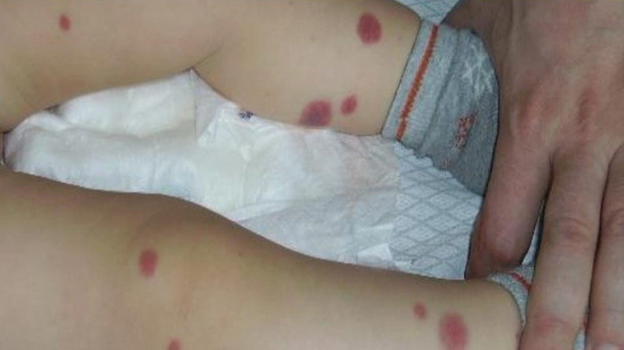 Il bimbo urla e ha convulsioni, la madre scopre qualcosa di atroce nelle lenzuola
