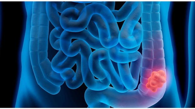 Tumore al colon, casi in aumento: i 4 sintomi da non sottovalutare