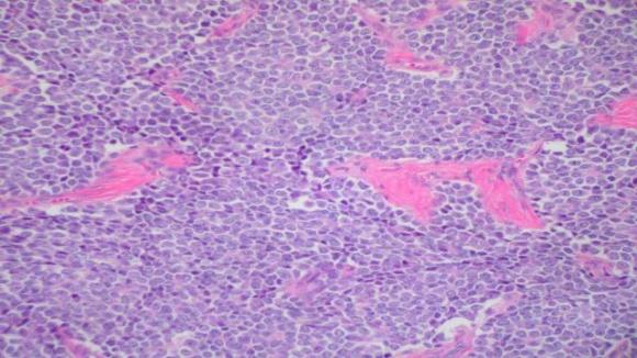 Sarcoma di Ewing, muore a 19 anni: il sintomo a cui prestare attenzione