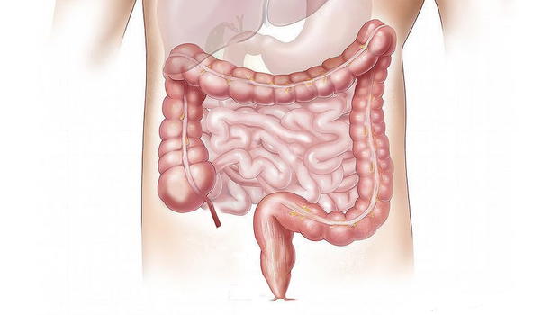 I 4 sintomi precoci del cancro al colon retto