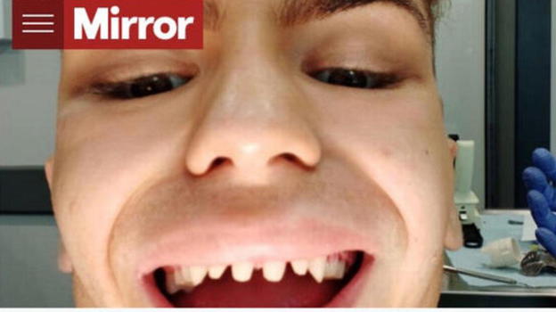 Il Vip per risparmiare si rifà i denti in Turchia, poi la terribile scoperta