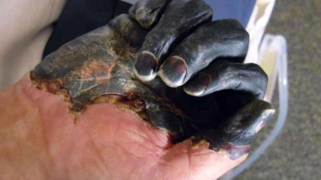 Morso dal gatto: arrivato in ospedale i medici fanno scattare l’allarme