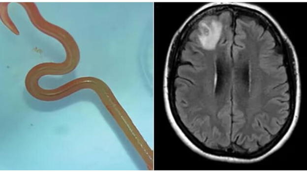 Soffriva di depressione, cosa le trovano nel cervello