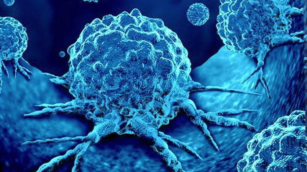Neoplasie in aumento del 79% nelle persone sotto i 50 anni: i motivi