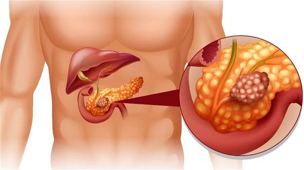 Neoplasia al pancreas, i segnali che ti salvano la vita