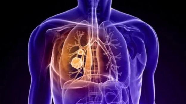 Neoplasia al polmone, non sottovalutate questi sintomi: potrebbero salvarvi la vita