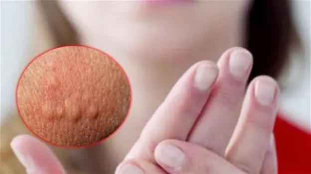 Ti sono uscite delle bollicine sul corpo come queste? Chiama subito il medico