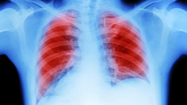Dopo la pandemia boom di neoplasie: ecco quali colpiscono di più