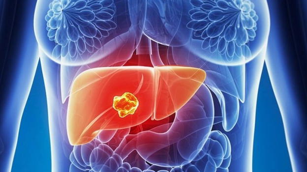 Neoplasia al fegato, ecco i sintomi a cui prestare attenzione