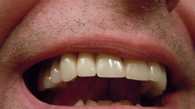 Neoplasia allo Stomaco, i primi segni in bocca anni prima dei sintomi