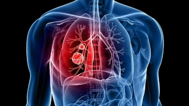 Neoplasia al polmone: aumenta la sopravvivenza del 60%: cos’è e come funziona