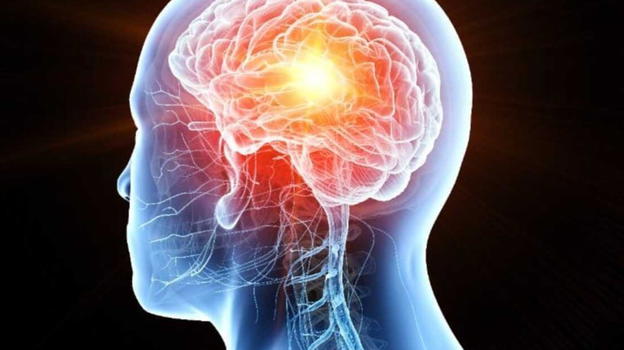 Neoplasia al Cervello: i sintomi a cui prestare attenzione