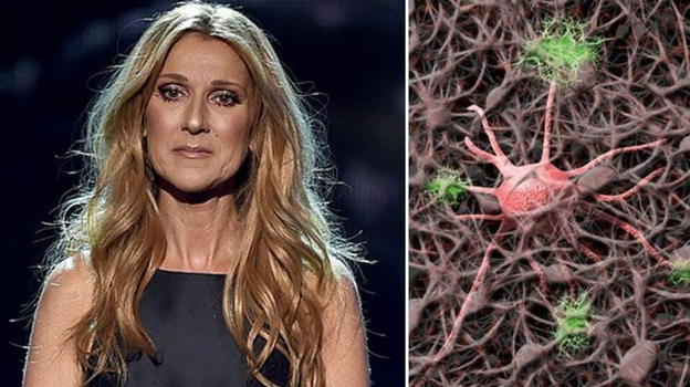 Céline Dion, sindrome della persona rigida: cos’è e quali sono i sintomi