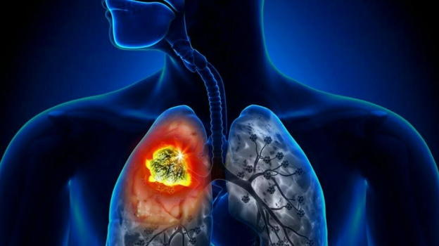 Neoplasia del polmone, i sintomi a cui prestare attenzione