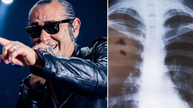 Luca Carboni, neoplasia ai polmoni: cos’è e quali sono i sintomi