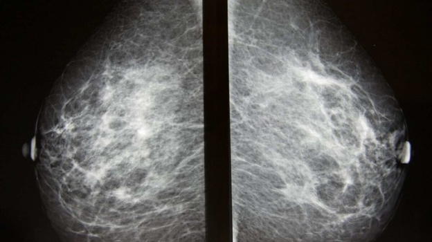 Neoplasia al seno, la notizia è arrivata poco fa: le sostanze che lo alimentano