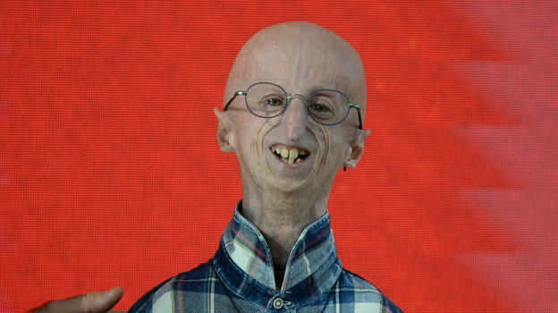 Ciao Sammy, l’Italia piange il più longevo di Progeria