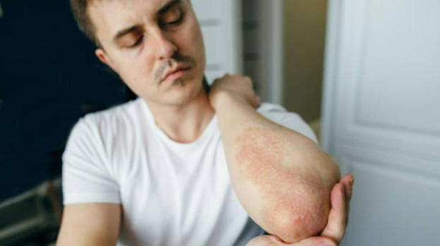 Psoriasi, colpiti oltre 2milioni di italiani ma nessuno sa che è collegata ad un’altra malattia