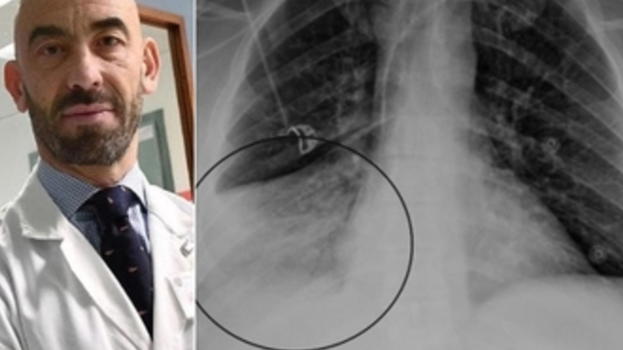 Virus Hmpv, Matteo Bassetti gela tutti: "Non c’è cura ed è già in Italia"