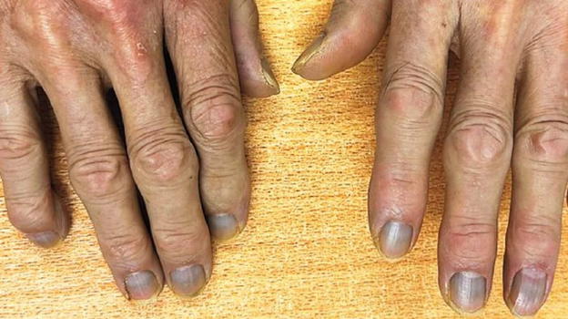 Si presenta in ospedale con una strana pelle grigia: la scoperta dei medici