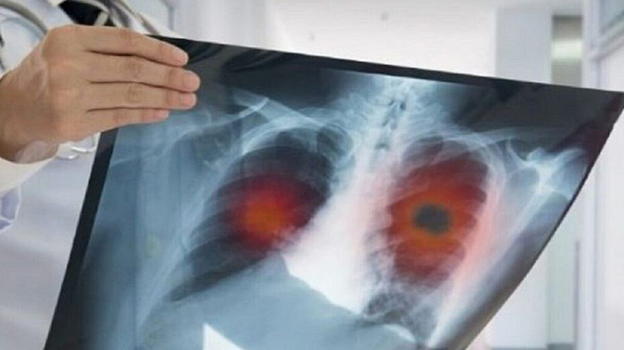 Boom di neoplasie nei giovani, scatta l’allarme. La scoperta degli esperti poco fa
