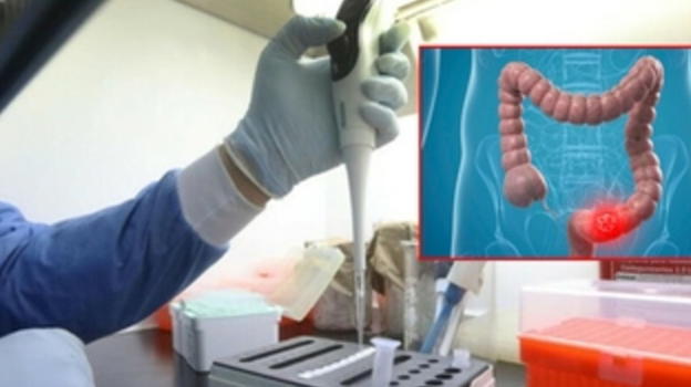 Neoplasia al colon nei giovani: i 3 fattori di rischio