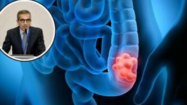 Neoplasia Colon, raddoppiati i casi nei giovani: cause e sintomi
