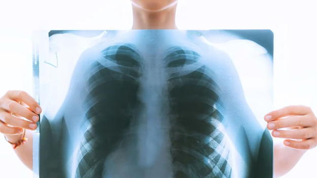 Cosa c’è dietro l’aumento di neoplasie al polmone dei non fumatori: lo studio parla chiaro