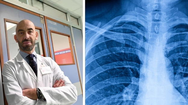 Polmoniti, è boom di ricoveri: 150mila in ospedale, 9mila decessi