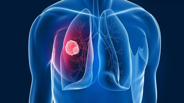 Mesotelioma, l’annuncio degli esperti: ecco i sintomi