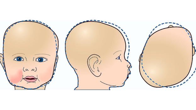 Craniostenosi, l’annuncio degli esperti: ecco i sintomi
