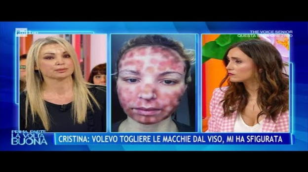Cristina, il trattamento finisce male: il viso pieno di cicatrici dopo il…