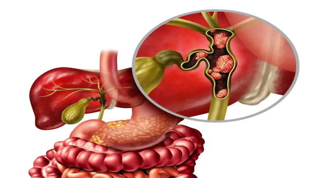 Neoplasia alla cistifellea e alle vie biliari: "Attenzione, inizia sempre con un…"