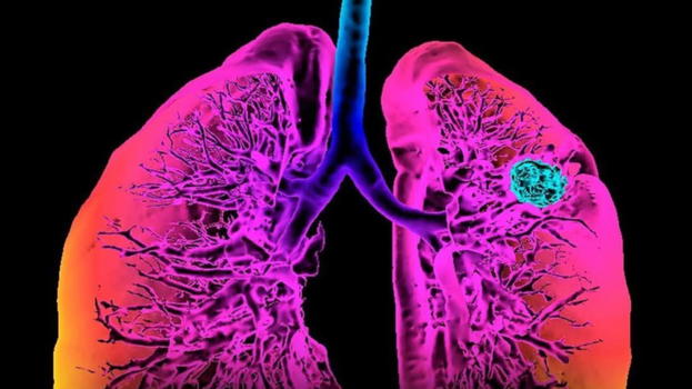Cancro ai polmoni, il segnale spia che ti salva la vita