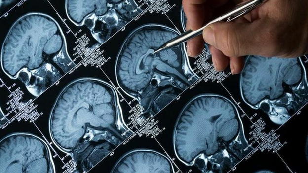 Test Alzheimer con accuratezza del 92%: ecco come scoprirlo