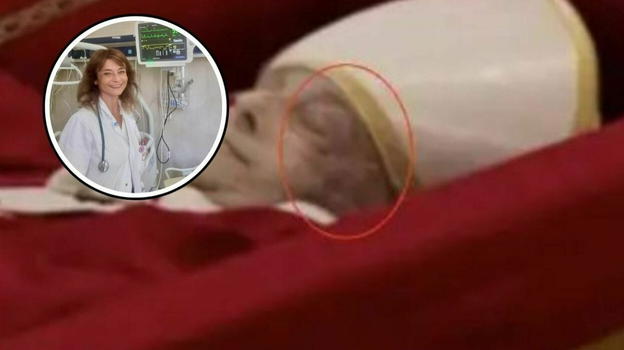 Papa Francesco, ecco cosa c’è dietro la strana macchia sul volto nelle immagini della salma