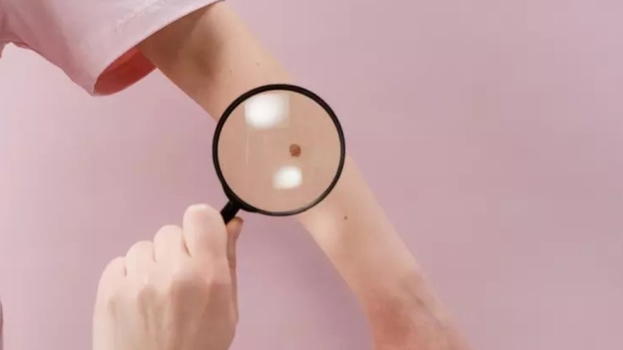 Melanoma, aumento dell’80% dei casi se tra i 15 e 20 anni hai fatto questo