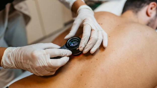 Melanoma, l’avvertimento degli esperti: si previene 9 volte su 10, i 7 errori da evitare