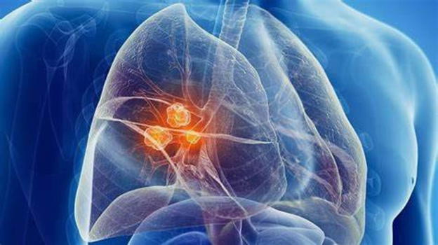 Scopre di avere una neoplasia ai polmoni dopo alcuni sintomi insoliti