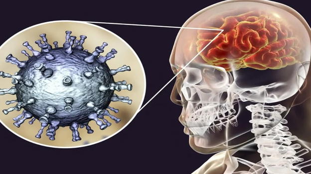 L’herpes labiale e il subdolo legame con l’Alzheimer