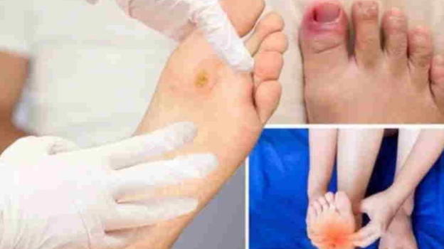 Piede diabetico, attenzione a questi 7 segnali
