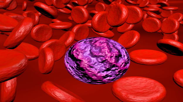 Leucemia mieloide, ecco i sintomi a cui prestare attenzione
