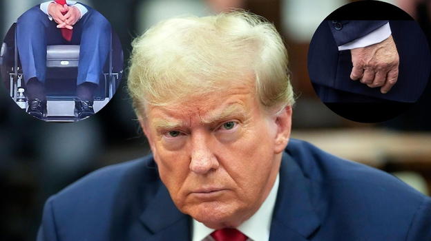 Trump, lividi su mani e piedi: sono le conseguenze dell’effetto della..
