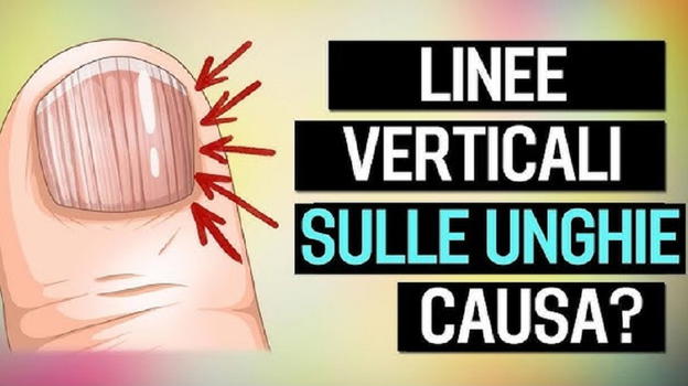 Ecco perché hai le unghie con strisce o righe verticali