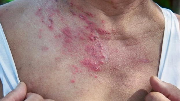 La patologia causata dalla stress: "Favorisce la riattivazione del virus"