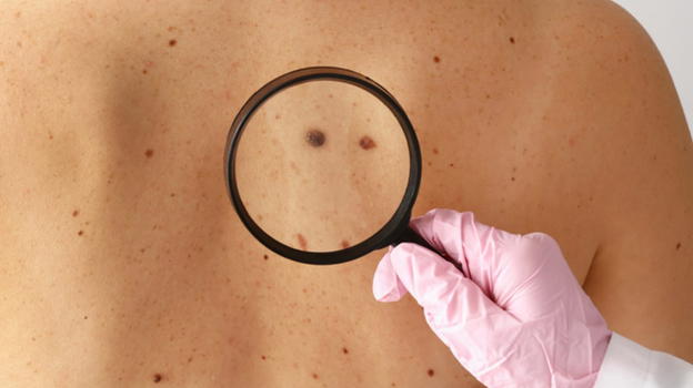 Melanoma metastatico ecco i sintomi a cui prestare attenzione