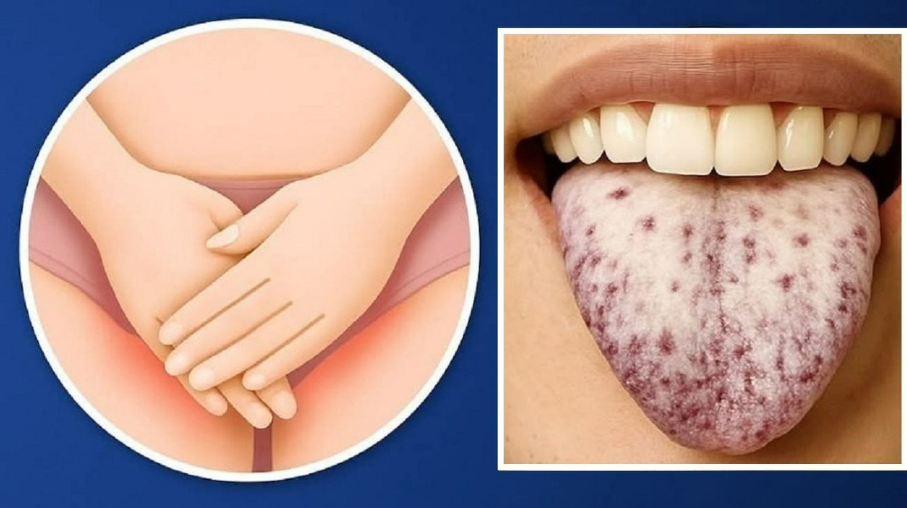 Ecco cosa significa avere la lingua bianca