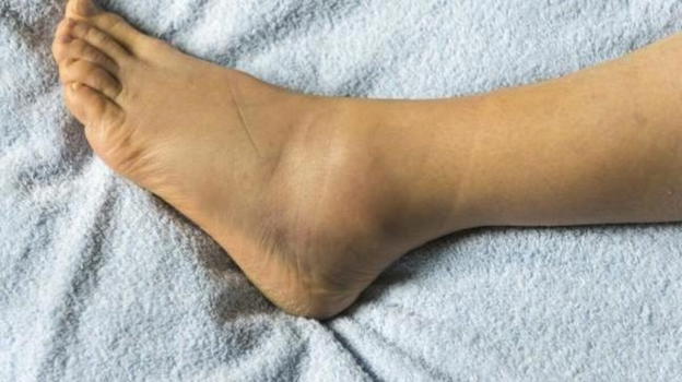 Gambe, piedi o caviglie gonfi: la causa che deve allarmarti